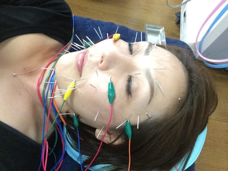 美容鍼の施術イメージ