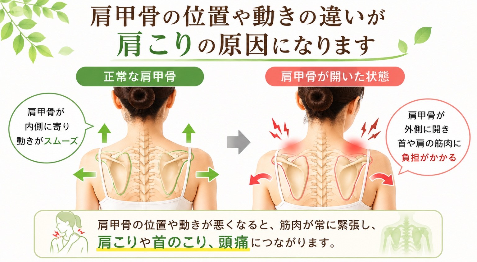 肩甲骨の位置や動きの違いが肩こりや首こり、頭痛につながることを示したイラスト